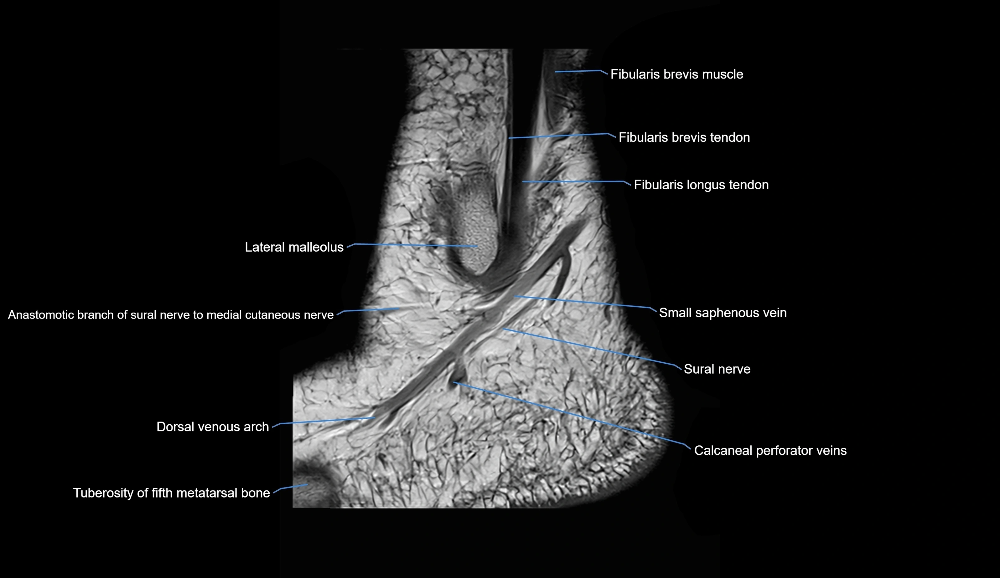MRI Ankle sagittal cross sectional anatomy 3T  radiology  image-img-00001-00033.webp